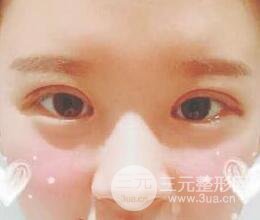 三點定位雙眼皮整形恢復(fù)圖案例