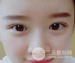 三點定位雙眼皮整形恢復(fù)圖案例