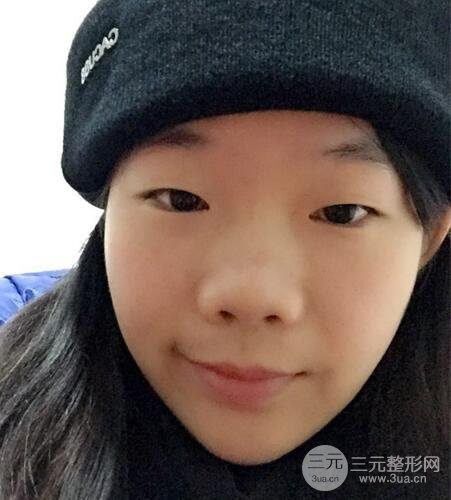 硅膠隆鼻+耳軟骨墊鼻尖+鼻小柱延長案例