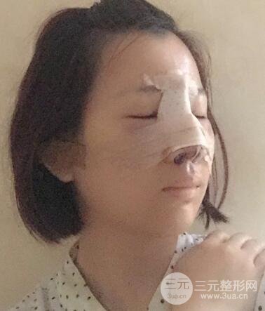 硅膠隆鼻+耳軟骨墊鼻尖+鼻小柱延長案例