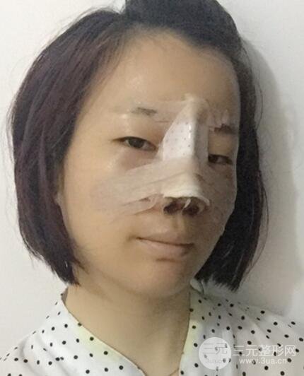 硅膠隆鼻+耳軟骨墊鼻尖+鼻小柱延長案例