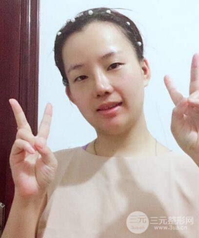 硅膠隆鼻+耳軟骨墊鼻尖+鼻小柱延長案例