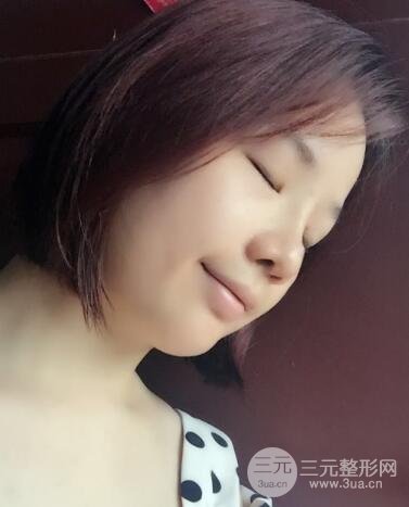 硅膠隆鼻+耳軟骨墊鼻尖+鼻小柱延長案例