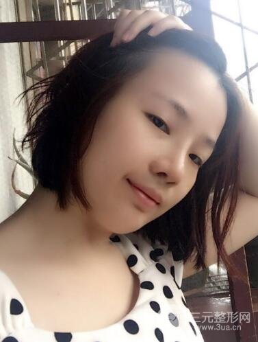 硅膠隆鼻+耳軟骨墊鼻尖+鼻小柱延長案例