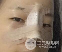 硅膠隆鼻+耳軟骨墊鼻尖+鼻小柱延長案例