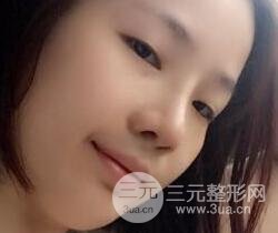 硅膠隆鼻+耳軟骨墊鼻尖+鼻小柱延長案例