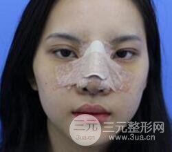 上海鼻子整形專家、價格和案例