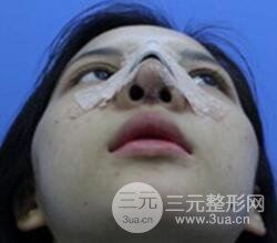 上海鼻子整形專家、價格和案例