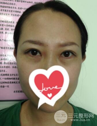雙眼皮修復(fù)術(shù)價錢和案例圖
