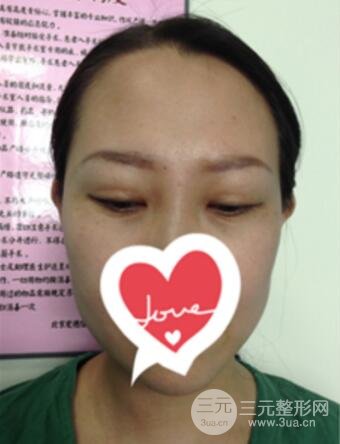 雙眼皮修復(fù)術(shù)價錢和案例圖