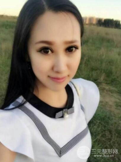 雙眼皮修復(fù)術(shù)價錢和案例圖