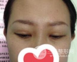 雙眼皮修復(fù)術(shù)價錢和案例圖