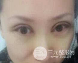 雙眼皮修復(fù)術(shù)價錢和案例圖