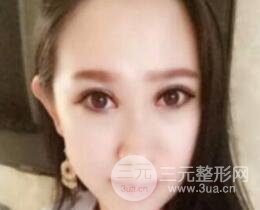 雙眼皮修復(fù)術(shù)價錢和案例圖