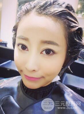 埋埋蛋白線.提升真實案例分享，珠海萊茵門診部馬中衛(wèi)醫(yī)生做的