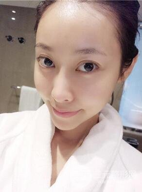 埋埋蛋白線.提升真實案例分享，珠海萊茵門診部馬中衛(wèi)醫(yī)生做的