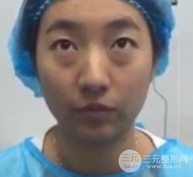 微創(chuàng)內(nèi)切去眼袋手術(shù)價(jià)格和恢復(fù)過程圖案例