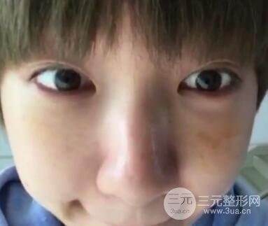 微創(chuàng)內(nèi)切去眼袋手術(shù)價(jià)格和恢復(fù)過程圖案例