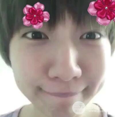 微創(chuàng)內(nèi)切去眼袋手術(shù)價(jià)格和恢復(fù)過程圖案例