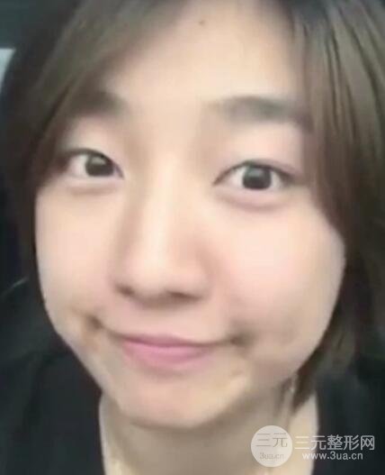 微創(chuàng)內(nèi)切去眼袋手術(shù)價(jià)格和恢復(fù)過程圖案例