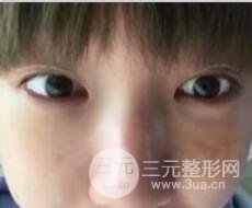 微創(chuàng)內切去眼袋手術價格和恢復過程圖案例