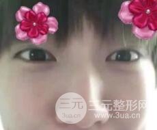 微創(chuàng)內切去眼袋手術價格和恢復過程圖案例