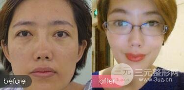 超聲法去眼袋價(jià)格和前后圖片案例