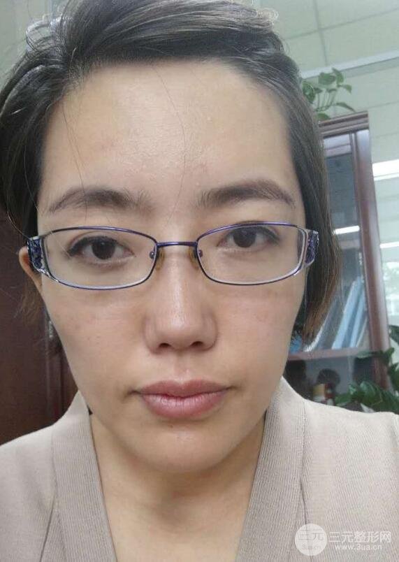 超聲法去眼袋價(jià)格和前后圖片案例