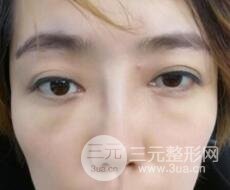 超聲法去眼袋價格和前后圖片案例