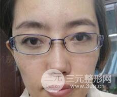 超聲法去眼袋價格和前后圖片案例