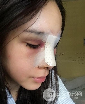 武漢美都張召醫(yī)生給我做的隆鼻整形手術，給大家分享一下前后照片