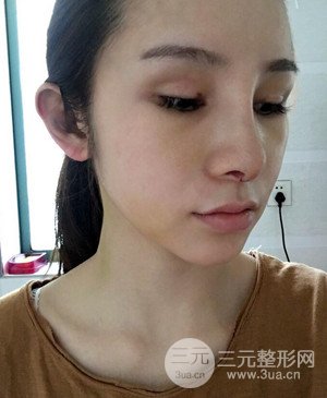 武漢美都張召醫(yī)生給我做的隆鼻整形手術，給大家分享一下前后照片