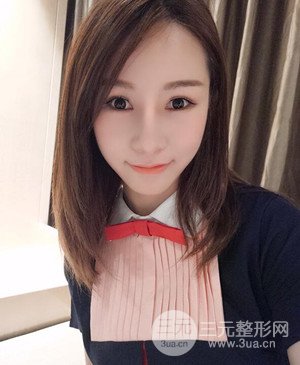 武漢美都張召醫(yī)生給我做的隆鼻整形手術，給大家分享一下前后照片