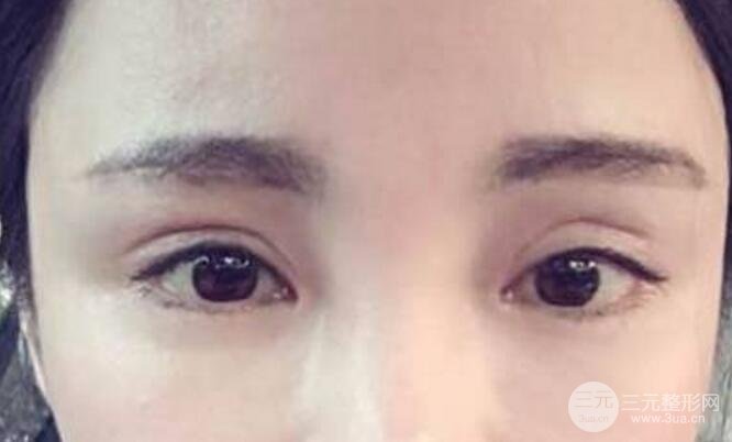 割雙眼皮失敗修復(fù)成功價格和案例圖片