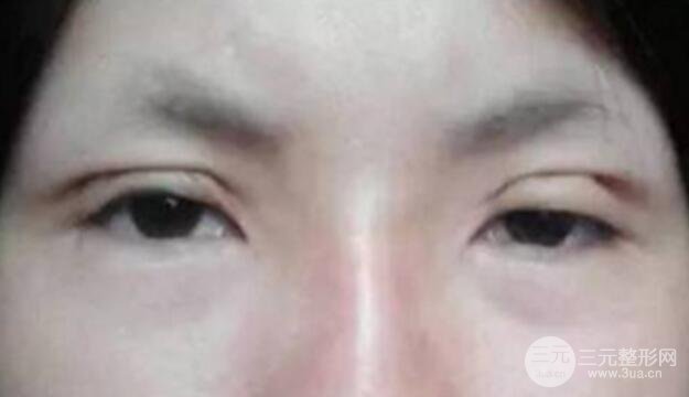 割雙眼皮失敗修復(fù)成功價格和案例圖片