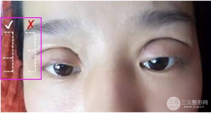 割雙眼皮失敗修復(fù)成功價格和案例圖片