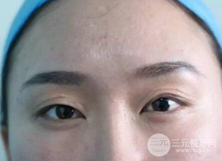 割雙眼皮失敗修復(fù)成功價格和案例圖片