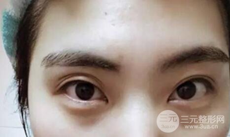 割雙眼皮失敗修復(fù)成功價格和案例圖片