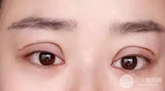 割雙眼皮失敗修復(fù)成功價格和案例圖片