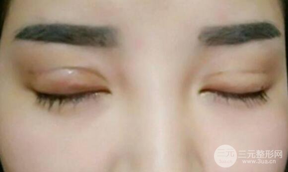 割雙眼皮失敗修復(fù)成功價格和案例圖片