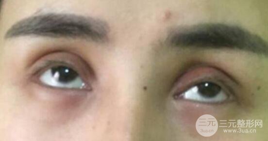 割雙眼皮失敗修復(fù)成功價格和案例圖片