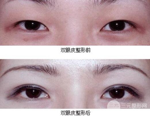 割雙眼皮失敗修復(fù)成功價格和案例圖片