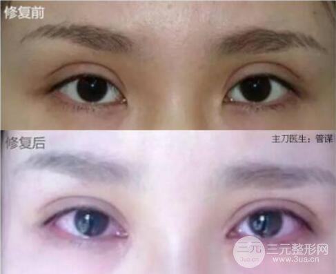 割雙眼皮失敗修復(fù)成功價格和案例圖片