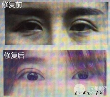 割雙眼皮失敗修復(fù)成功價格和案例圖片