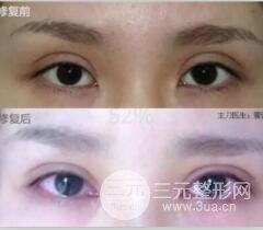 割雙眼皮失敗修復成功價格和案例圖片