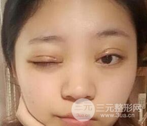 切開雙眼皮手術(shù)恢復(fù)過程圖案例