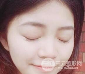 切開雙眼皮手術(shù)恢復(fù)過程圖案例