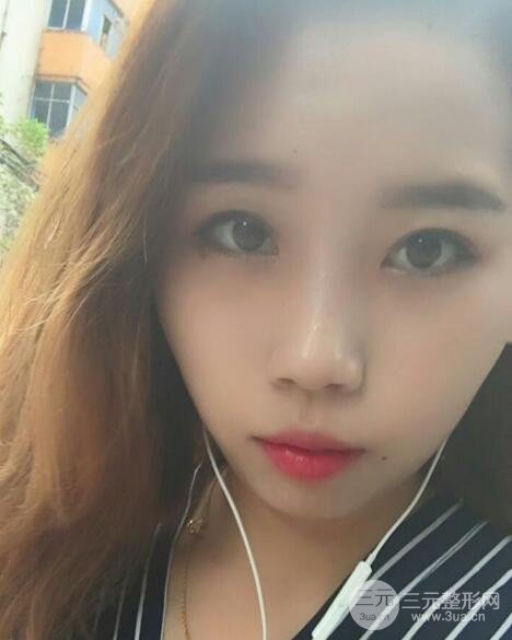 切開(kāi)雙眼皮無(wú)疤痕增生果圖案例