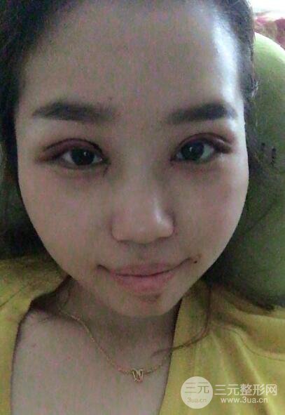 切開(kāi)雙眼皮無(wú)疤痕增生果圖案例