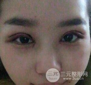 切開雙眼皮無疤痕增生果圖案例